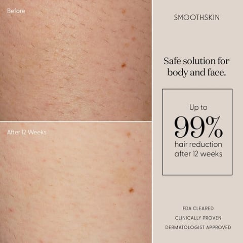 SmoothSkin Pure Fit IPL Hair Removal Device with Laser
